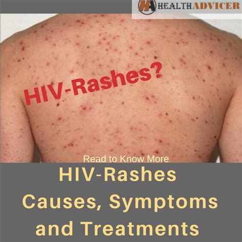 HIV Rashes Causes Picture Symptoms And Treatment