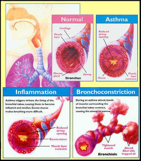 What Are The Effects Of Asthma On The Respiratory System