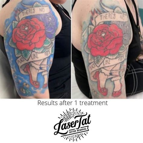 Top Tattoo Removal Cleveland In Cdgdbentre