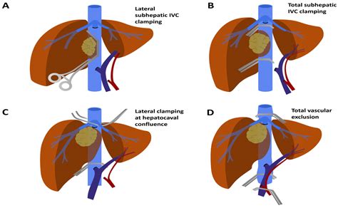 Cancers Free Full Text Vascular Involvements In Cholangiocarcinoma