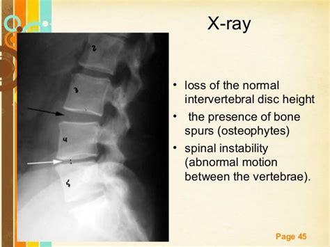 Prolapsed Intervertebral Disc X Ray Click To Enlarge Image Side