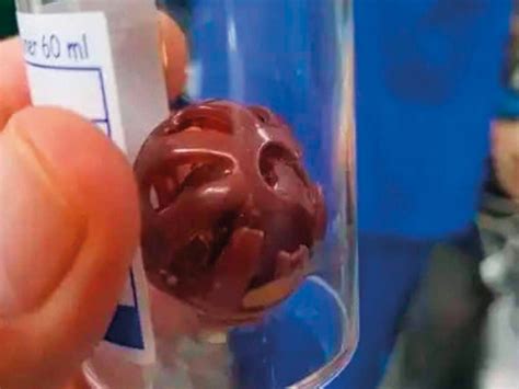 Infant Saved After Swallowing Plastic Ball Health Gulf News