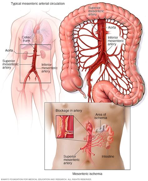 superior mesenteric artery syndrome treatment