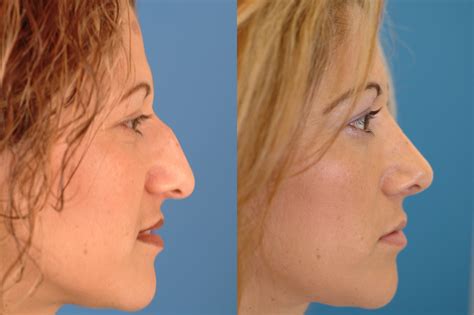 Rhinoplasty Before And After Photos Dr Benjamin Bassichis