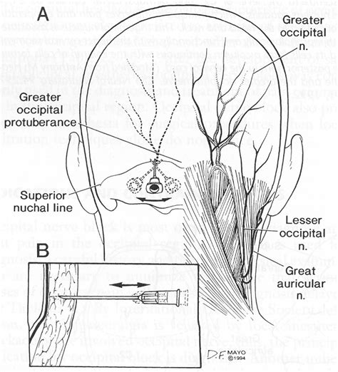 Case Study Occipital Neuralgia Briz Brain And Spine Radiofrequency