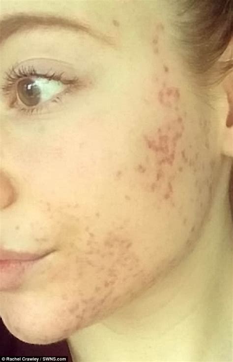Woman With Severe Acne Competes In Miss Preston Daily Mail Online