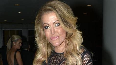 Burns Victim Dana Vulin Steps Out At Perths Pink Ribbon Gala Ball After Revealing Her New Face