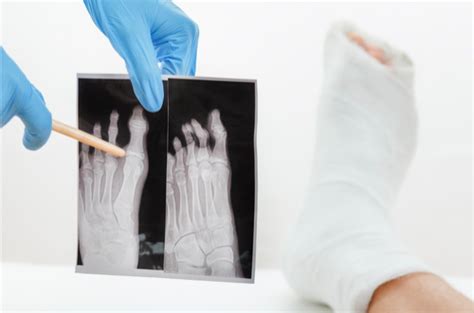 I migliori esercizi da fare dopo un'ingessatura del piede