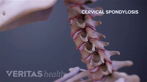 Cervical Spondylosis With Myelopathy Spine Health