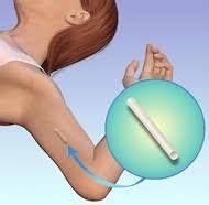 Arm Implant Birth Control STD Free Los Angeles Nexplanon Birth