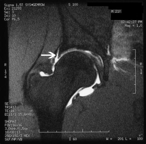Arthroscopic Labral Repair In The Hip Surgical Technique And Review Of
