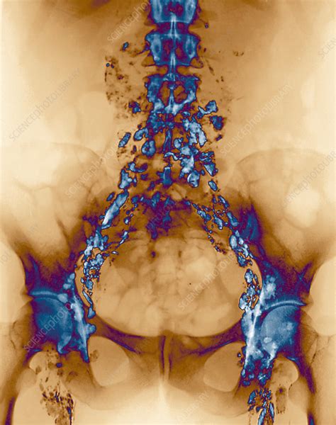 Hodgkins Lymphoma X Ray Stock Image M1340747 Science Photo Library