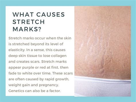 Improving Red And White Stretch Marks With Laser Treatments