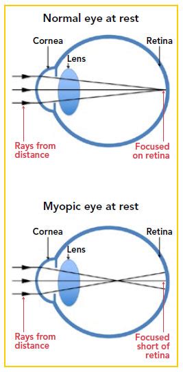 Childhood Myopia And The Use Of Atropine Eye Drops Singhealth