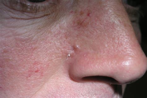 Skin Cancer Removal Before After Dr David Mueller Virginia Facial