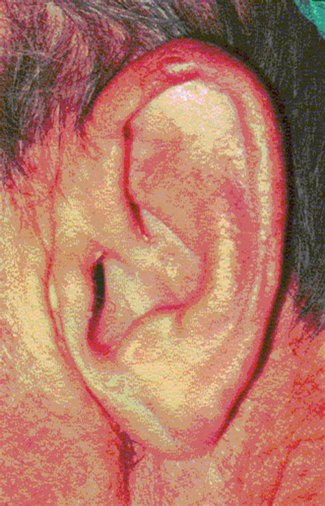 Normal Auricle Configuration And Skin Appearance Nodule On The Top Of