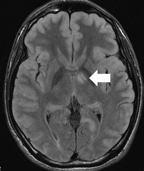 A T2wi Imaging Of The Brain Showed A Hyperintense Lesion At The Right