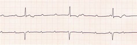 The complete absence of conduction results in a ventricular escape rhythm, whose rate depends on the level at which the escape rhythm is generated. ECGs at Newcastle University - StudyBlue