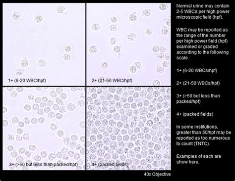 How We Report White Blood Cells Count In Urinalysis Medical Laboratories