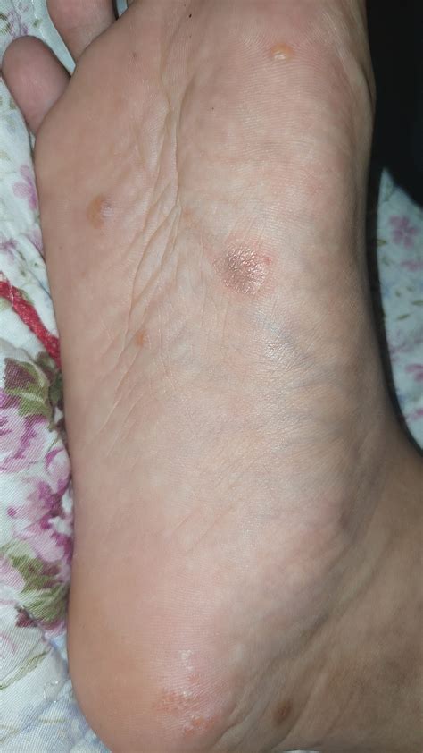 These Bumps Keeps On Appearing At The Bottom Of My Foot It Itches What Could This Be R