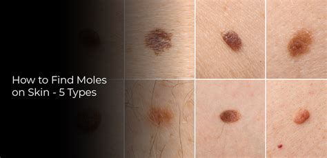 How To Find Moles On Skin 5 Types