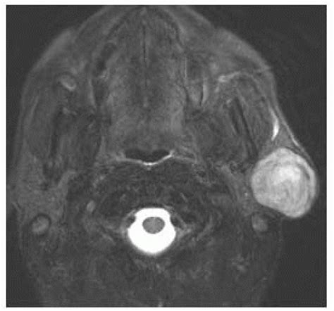 Neck Masses Radiology Key