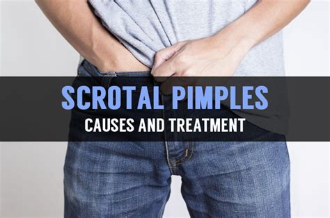 Causes And Treatment For Pimple On Scrotum Or Testicles