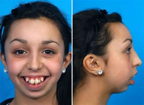 Her Jaw Stopped Growing When She Was 8 After Surgery Her