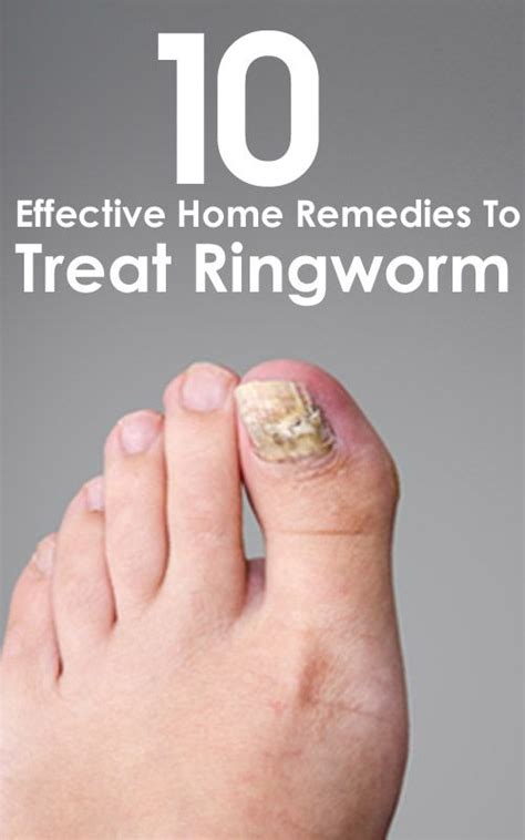 And, the most important question, how do you get rid of them right now? Home Remedies For Ringworms - 10 Ways To Treat The ...