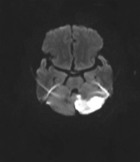 Left Posterior Inferior Cerebellar Artery Pica Infarct Image