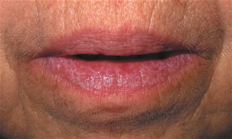 Acute Onset Reticulated White Lip Allergy And Clinical Immunology