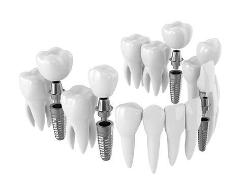 Dental Implants Step By Step