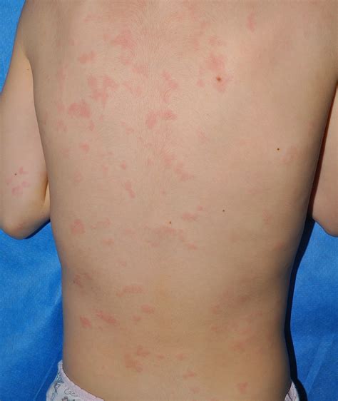 Skin Manifestations Of Covid‐19 In Children Part 2 Andina 2021
