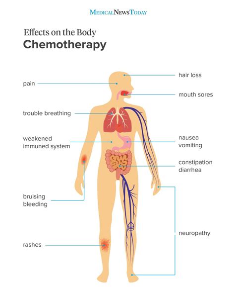 The Most Common Chemotherapy Side Effects