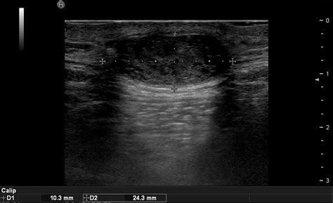 Ultrasound Image Of Epidermal Cyst Download Scientific Diagram