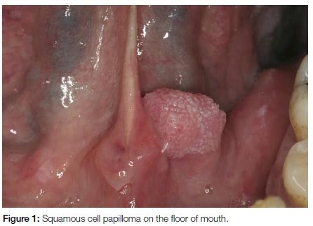 Hpv Tongue Lesions