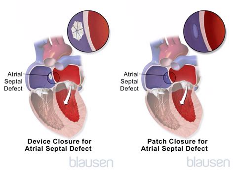 Heart Defects Ventricular Septal Defect Atrial Septal Defect Cleft