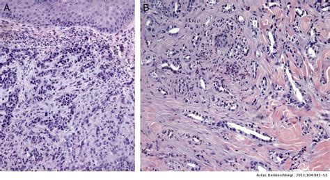 Cutaneous Metastases Of Internal Tumors Actas Dermo Sifiliográficas