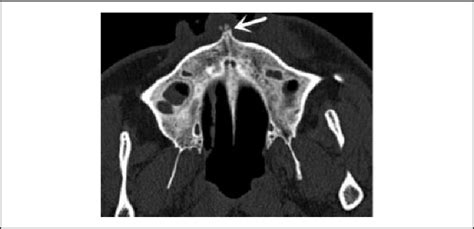 Axial Ct Image Of A 33 Year Old Man With A Triangular Type Anterior