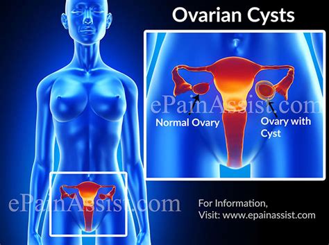 ovarian cysts causes types signs symptoms treatment prevention tests