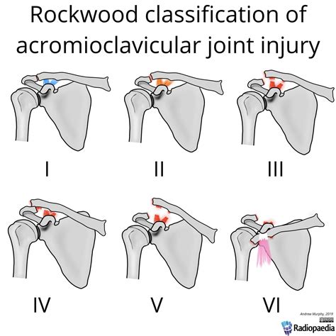 Rockwood Classification Of Acromioclavicular Joint Injury Aliem