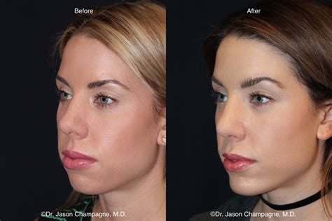 Chin Implant Gallery Beverly Hills Plastic Surgeon Dr Jason Champagne