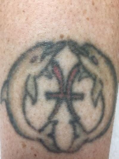 When you get a tattoo the ink is injected into a tattoo removal cream can help to fade tattoos so that they are less noticeable. Removing a Leg Tattoo with Laser, Moon Twp, PA - Beaver ...