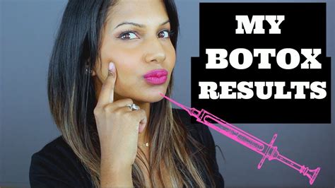 My Botox Results Getting Botox Done My Experience With Botox Youtube