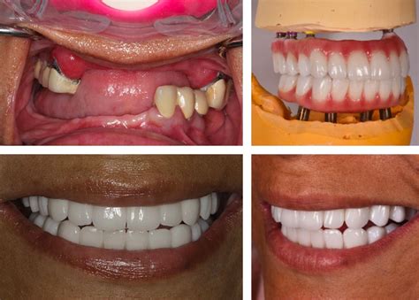 All On 4 Dental Implants Before And After