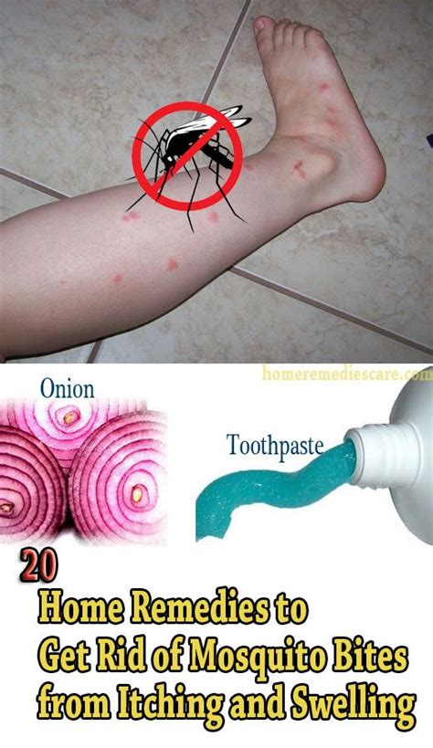 Home Remedies Care — 20 Home Remedies To Get Rid Of Mosquito Bites From
