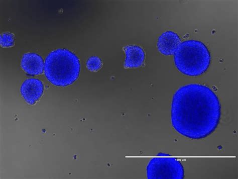 , ionkin d.a., zhavoronkova o.i., vetsheva n.n., shurakova a.b., bugaev s.a., kungurtsev c.v. Diffuse Intrinsic Pontine Glioma (DIPG) : Bindra Lab