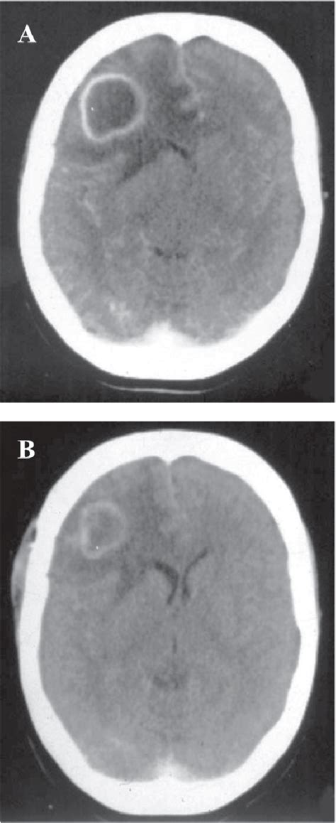 Figure 1 From Tuberculous Brain Abscess In A Patient With Aids Case