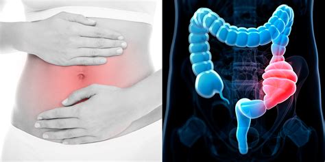 Can you get a fever from constipation. Rectocele Causes And Symptoms | SELF