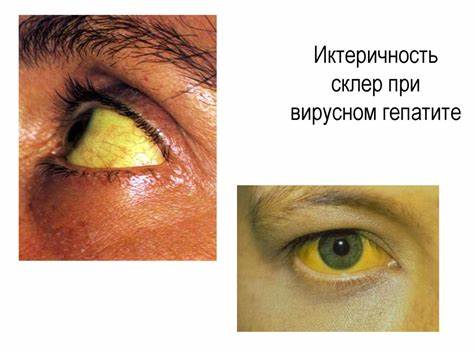 Диагностический поиск при вирусных гепатитах. Клиническо Картинка - Диагностический поиск при вирусных гепатитах. Клиническо